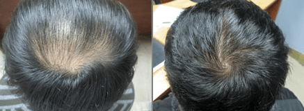 Anti Hair Loss Growth Serum – Restore, Strengthen & Regrow Naturally